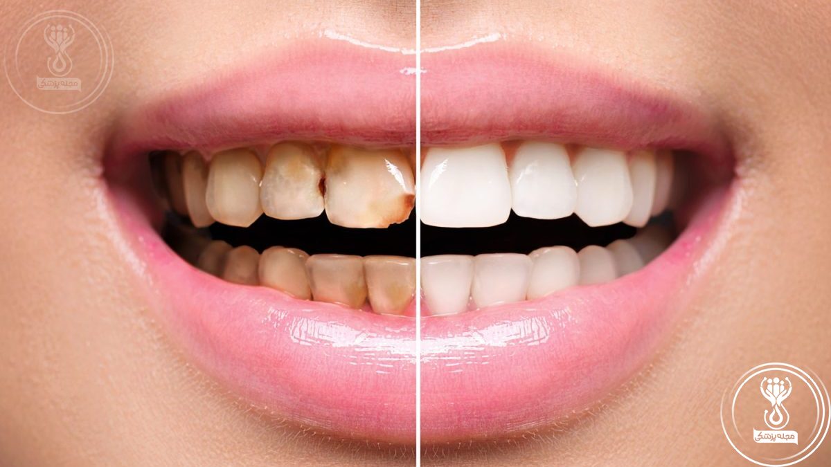 کامپوزیت دندان و اثر آن بر زیبایی