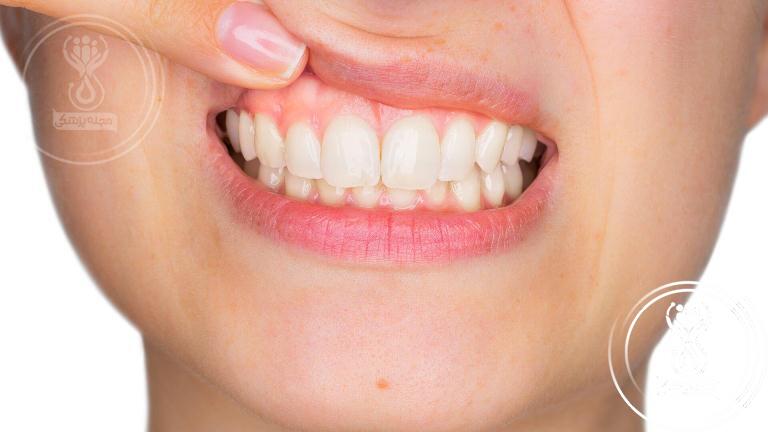 عفونت لثه یکی از عوارض کامپوزیت دندان