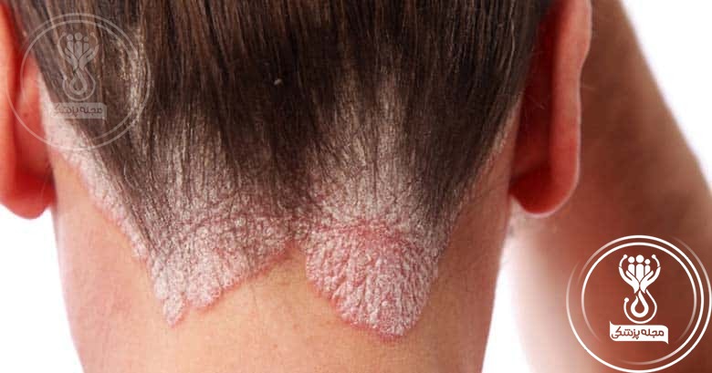داروهای مقابله با عفونت‌های قارچی درمان ریزش مو سکه ای