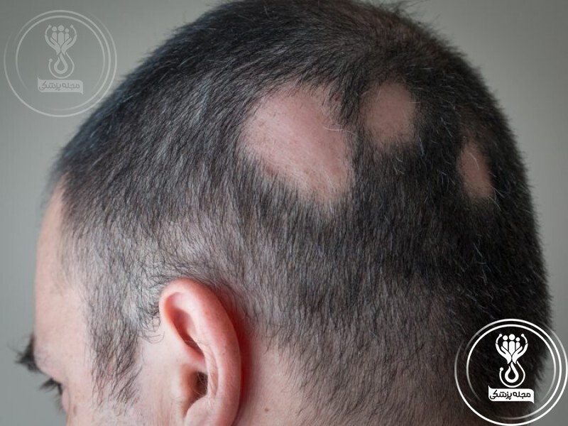 بهترین درمان ریزش مو زنان و مردان