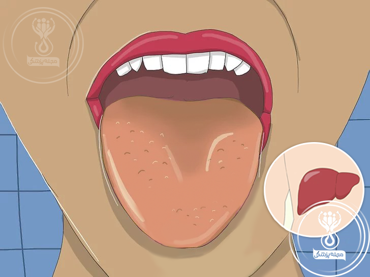 زردی زبان؛ از علائم کبد چرب بر روی زبان