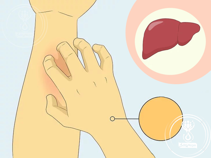 تشخیص کبد چرب از روی علائم زردی، تورم و خارش دست 